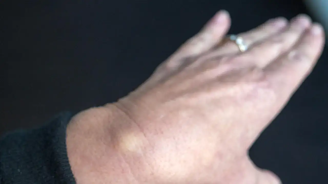 Ein kleiner, gelblicher Schleimbeutel am Handgelenk einer Person mit einem Ring.