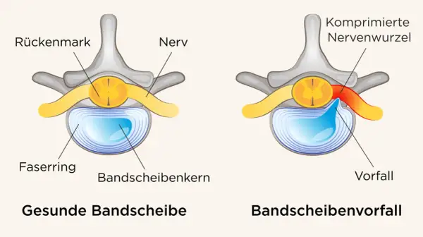Vergleich gesunde Bandscheibe vs. Bandscheibenvorfall. Ein Vorfall drückt auf Nerven, was zu quälenden Bandscheibenvorfall Schmerzen gehen nicht weg führen kann.